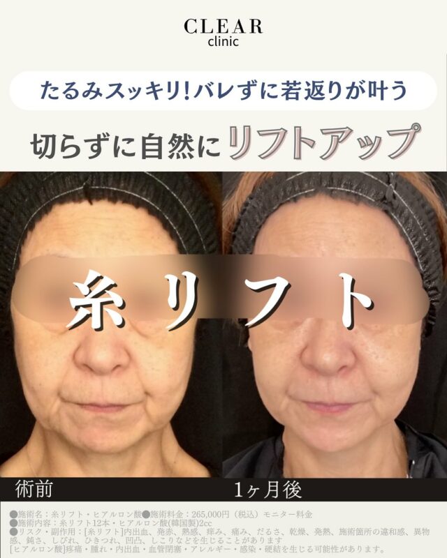たるみスッキリ！バレずに若返りが叶う 切らずに自然にリフトアップ