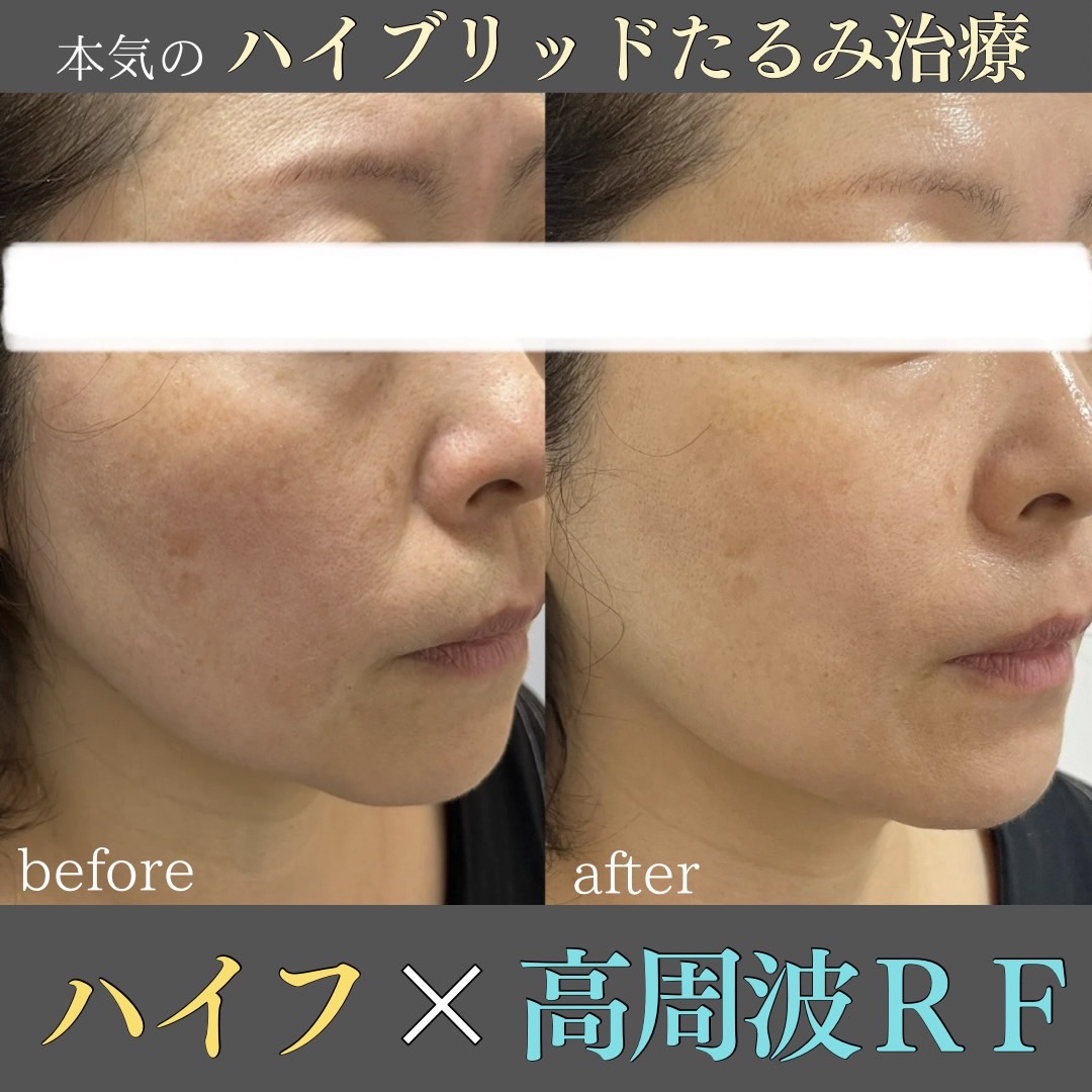 フラクショナル冷却RF 高周波リフト