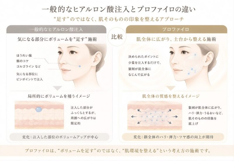 足すのではなく、肌のそのものの印象を整えるアプローチ。一般的なヒアルロン酸注入：気になる部分にボリュームを足す施術（ほうれい線、頬のコケ、ゴルゴラインなど、気になる部位にピンポイントで注入）、局所的にボリュームを補うイメージ（注入した部分がふっくらとするが、周囲への広がりは限定的）、変化：注入した部位のボリュームアップが中心。プロファイロ：肌全体に広がり、土台から整える施術（決められたポイントに少量を注入するだけで、製剤が肌全体になじんで広がる）。肌全体の質感を整えるイメージ（製剤が肌全体に広がり、ハリ・弾力・うるおいなど、肌そのものの印象を底上げ）。変化：顔全体のハリ・弾力・ツヤ感の向上が期待。プロファイロは、ボリュームを足すのではなく、肌環境を整えるという考え方の施術です。