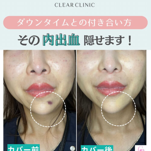 🍀︎ダウンタイム(内出血)との付き合い方🍀