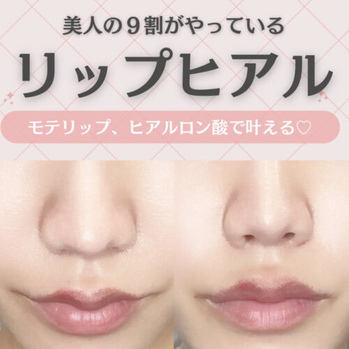 💄👄💕唇のヒアルロン酸