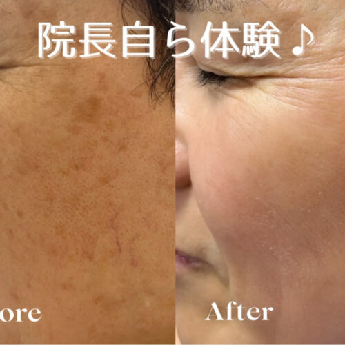 ピコフラクショナルレーザーで肌質改善！✨