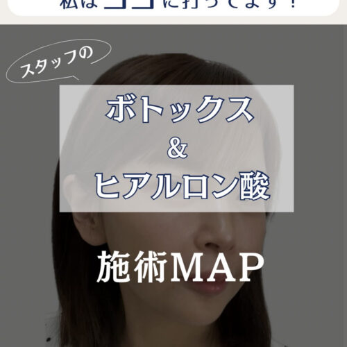 \\スタッフの[ボトックス][ヒアルロン酸] 施術MAP公開❗️//