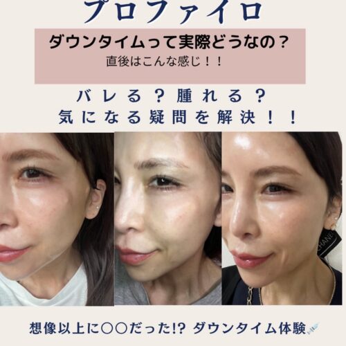 肌そのものを若返らせる、次世代スキンブースター💎プロファイロ💎 肌そのものを若返らせる、次世代スキンブースター💎プロファイロ💎