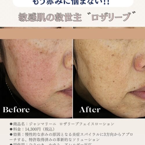 ロザリーブ フェイスローション😀赤み・ほてりケアに特化した医療発想スキンケア✨ ロザリーブ フェイスローション😀赤み・ほてりケアに特化した医療発想スキンケア✨